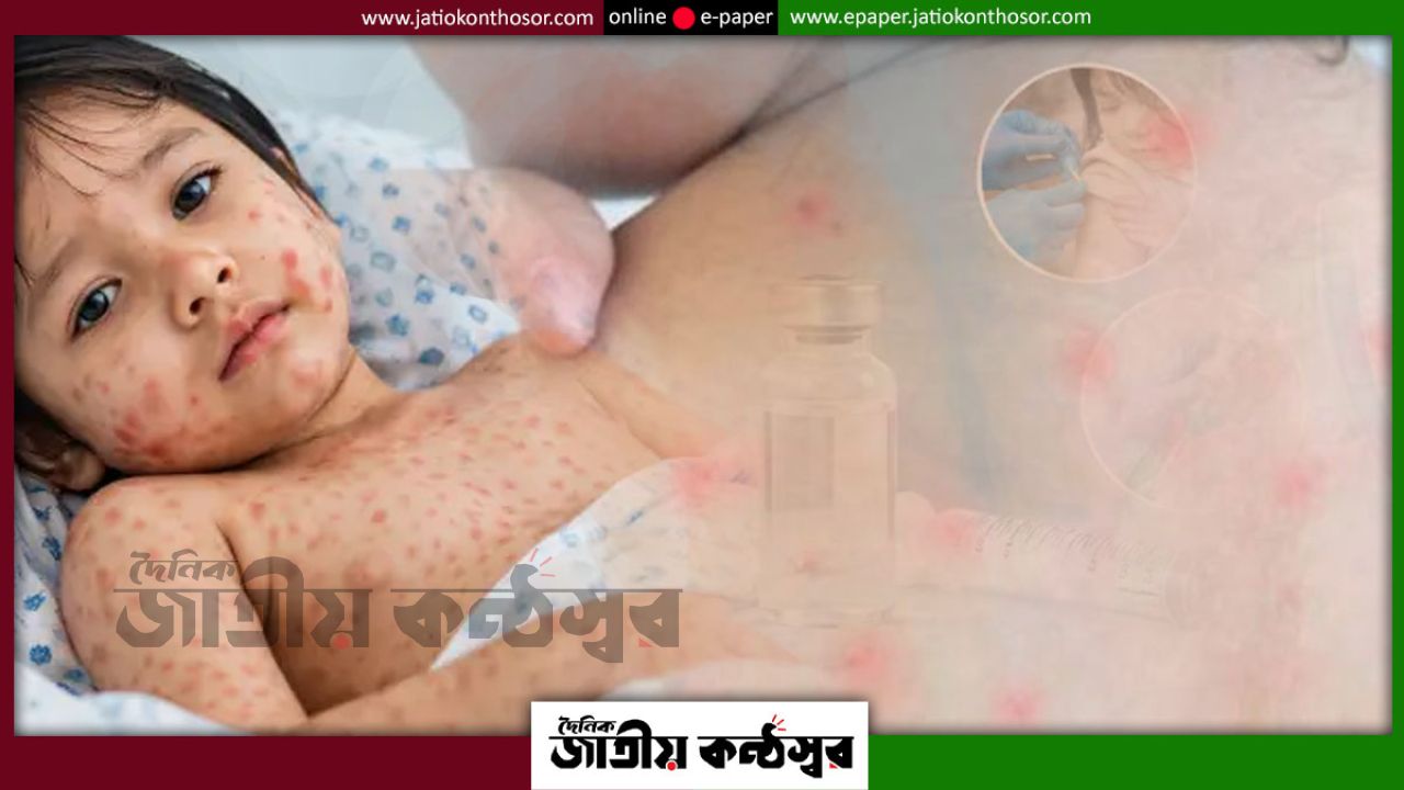 দেশে ভয়াবহ আকার নিচ্ছে হাম, ২৪ ঘণ্টায় আরও ৫ মৃত্যু; আক্রান্ত প্রায় ৬৮ হাজার